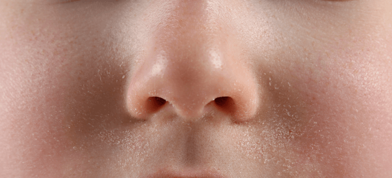 dry flaky skin around nose