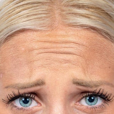 forehead wrinkle cure