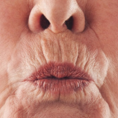 lip line wrinkles