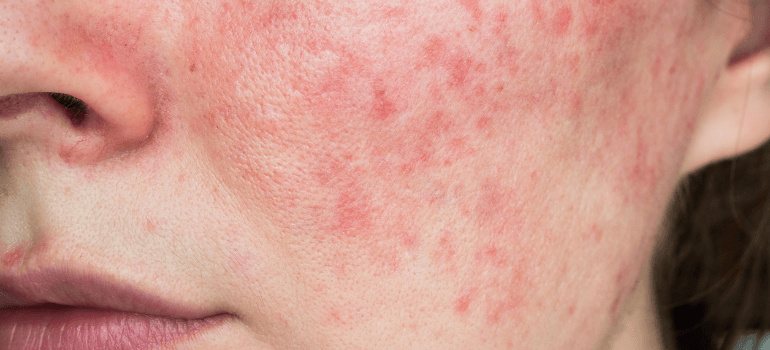 help heal skin reactions