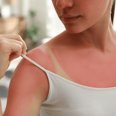 sunburnt shoulder