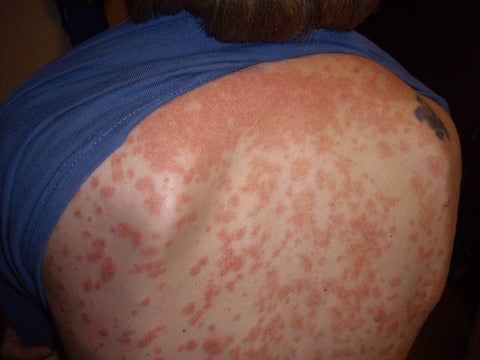 Guttate Psoriasis: This type often appears after a bacterial or viral infection, such as strep throat. It causes small, red spots (aka lesions) to develop on the skin. Guttate psoriasis can affect larger areas of the body and is more common in children and young adults.