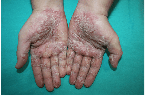 Palmoplantar Psoriasis: This type affects the palms of the hands and soles of the feet. It causes thickened, red, and scaly skin that can be painful and impact daily activities.