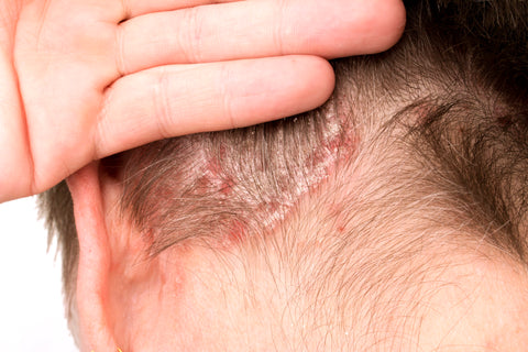 Scalp Psoriasis: Psoriasis on the scalp can result in red, scaly patches and silvery-white scales. It can extend beyond the scalp to the forehead, neck, and behind the ears.