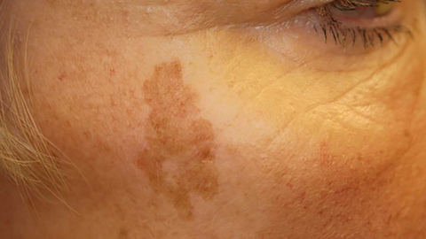 Sunspots are a common symptom of sun-damaged skin