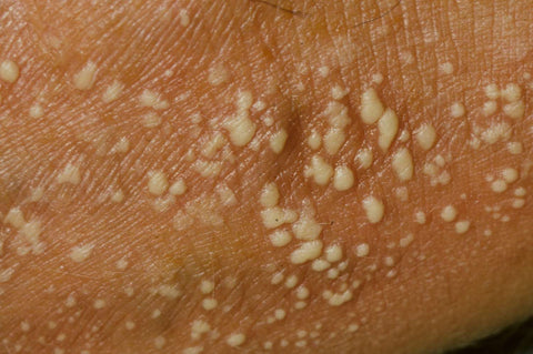 Pustular Psoriasis: Pustular psoriasis is characterized by white pustules surrounded by red skin. These pustules contain non-infectious pus and can be painful. This type can be localized to certain areas of the body or cover larger areas.