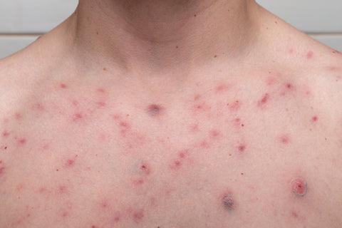 chest acne