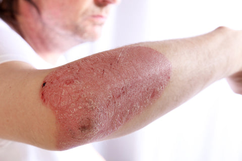Plaque Psoriasis (also known as Psoriasis Vulgaris): This is the most common type of psoriasis and is characterized by raised, red patches of skin covered with silvery-white scales. These patches, known as plaques, usually appear on the elbows, knees, scalp, and lower back.