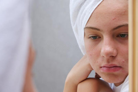 Ever wonder why you still get acne breakouts after a night of wearing makeup even though you washed off your makeup?