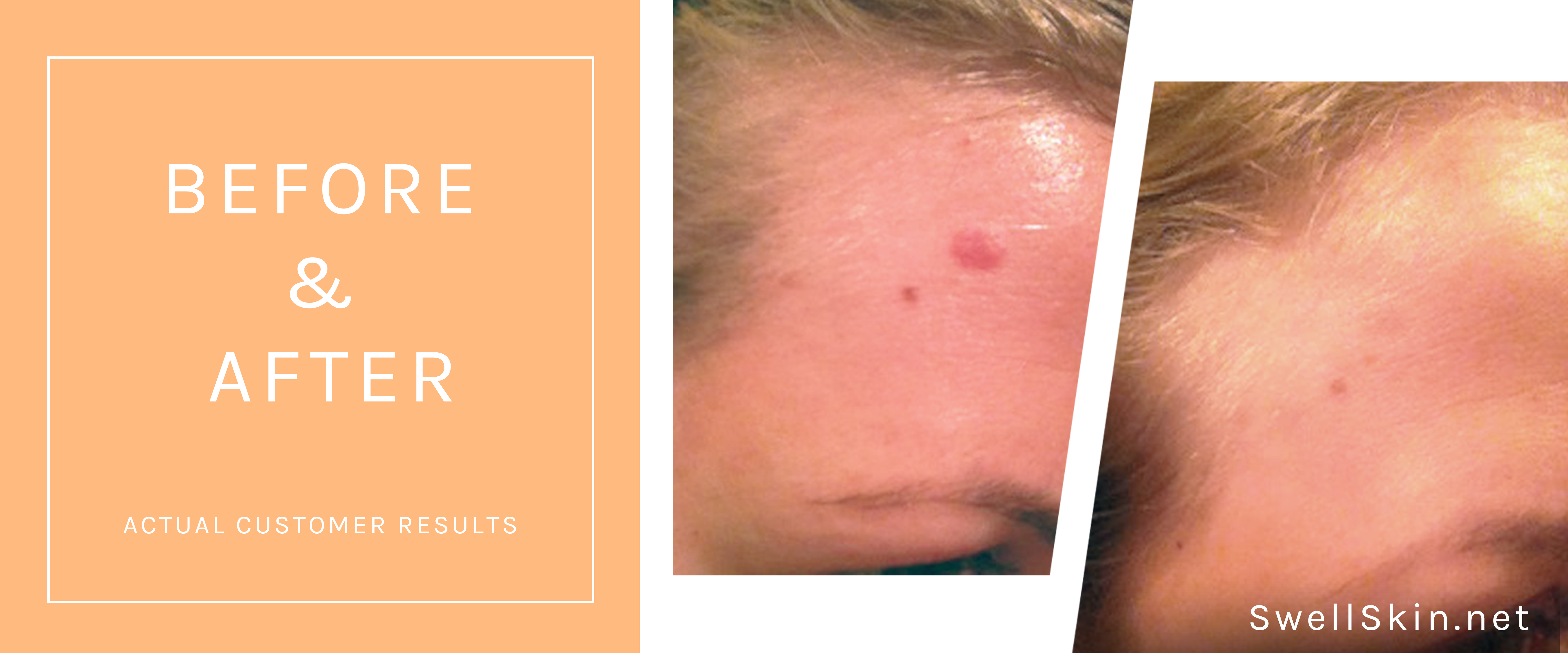 Swell Skin Before & After Photos - Actual Customer Results - Best Skin Ever - Clear Skin - Skincare