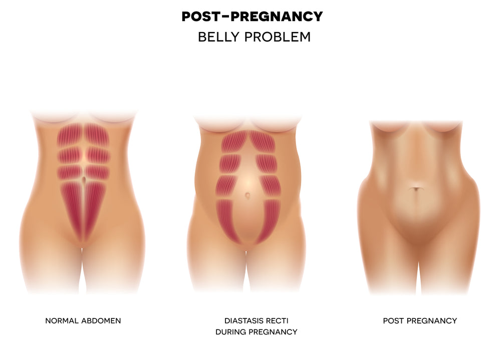 Postpartum Diastasis Recti – Image from Shutterstock