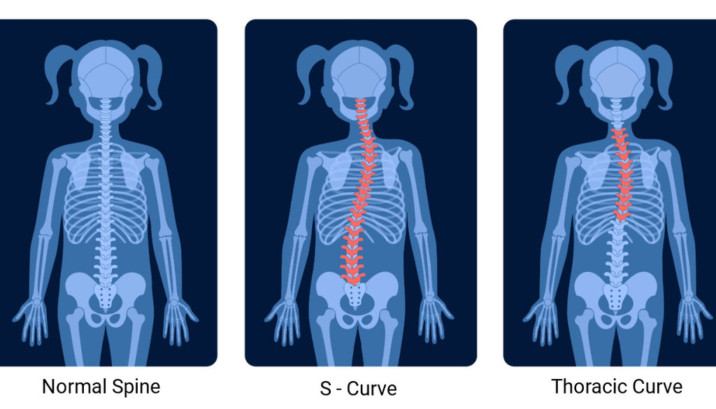 Types of scoliotic curvatures