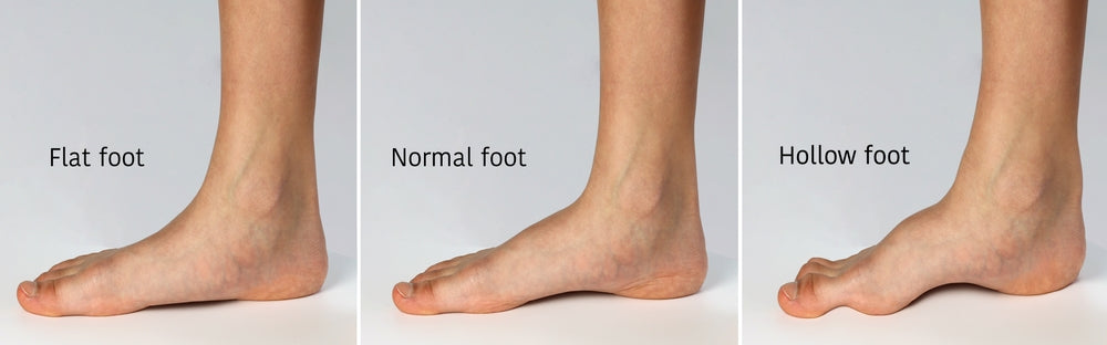 Improper biomechanics of the feet