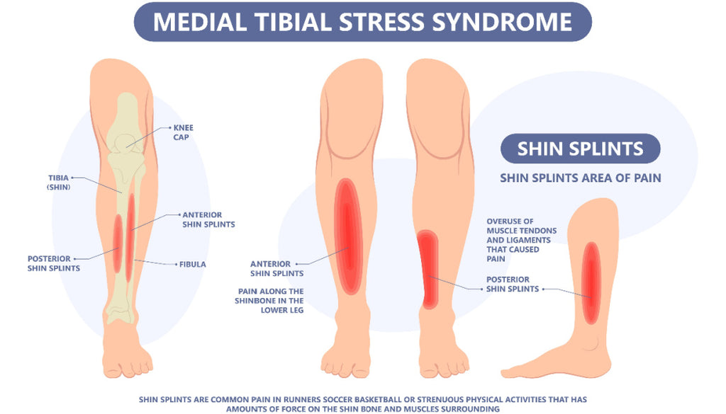 Shin Splint Diagram