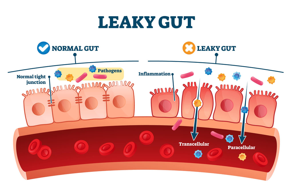 Can Alcohol Cause Leaky Gut?