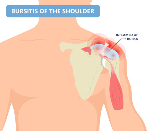 diagram describing shoulder bursitis