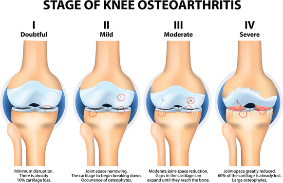 lasertherapie van de knie