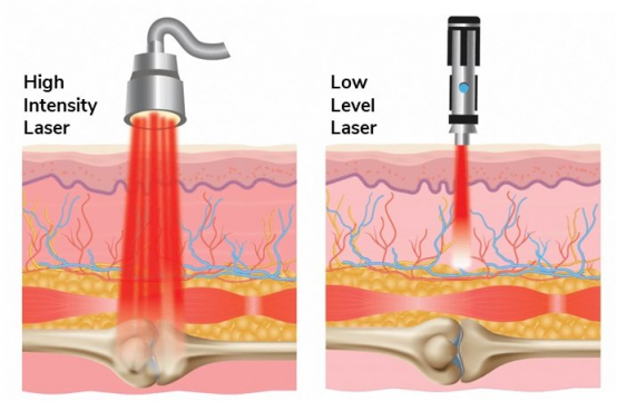 thérapie au laser des tissus profonds