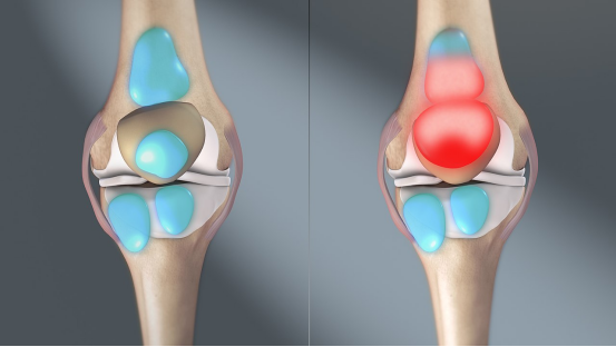 thérapie au laser du genou