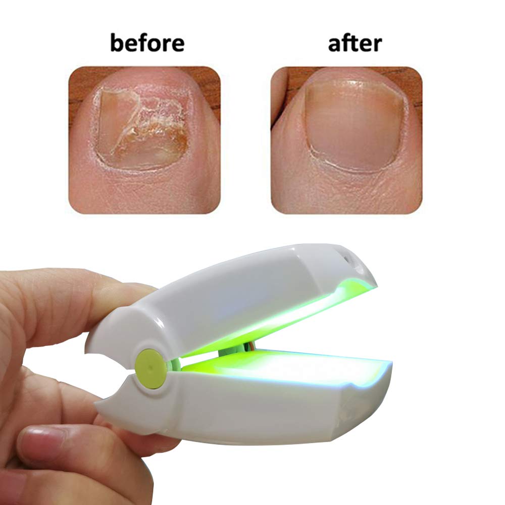 Most effective laser therapy for nail fungus removal for home use