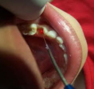 Lasertherapie voor endodontische aandoeningen