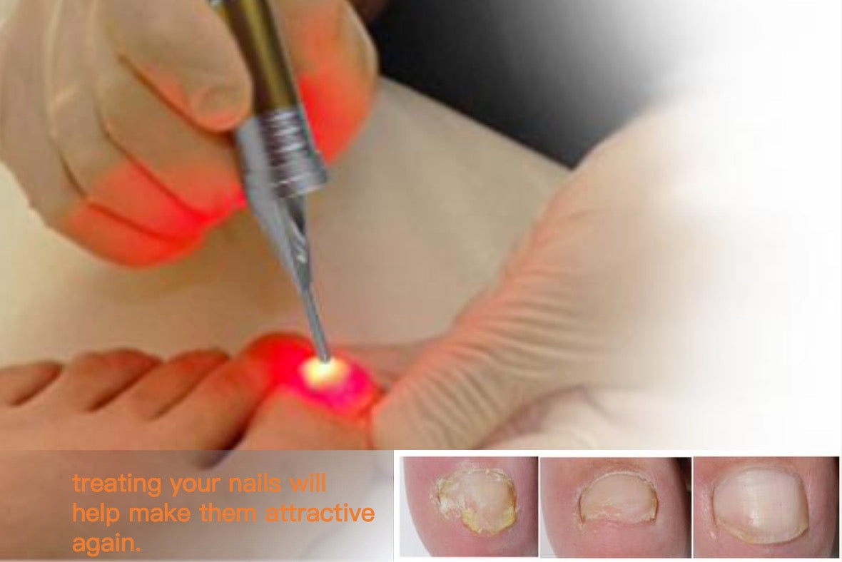 Nail Fungus Treatment Laser 