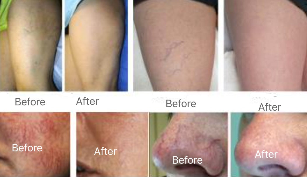 Class 4 laser for vascular removal