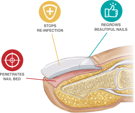 EmoniNail™ - Nail Fungus Treatment