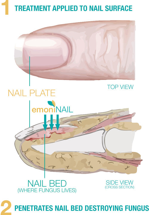 How It Works – EmoniNail™ - Nail Fungus Treatment