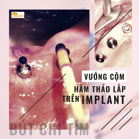 Xác định điểm vướng cộm hàm tháo lắp trên implant - 49P