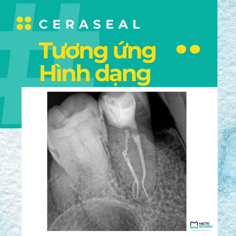 Ceraseal - Cement trám bít sinh học - tương ứng hình dạng