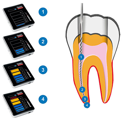 Chỉ định sử dụng máy định vị chóp Propex Pixi Dentsply Sirona - 49P