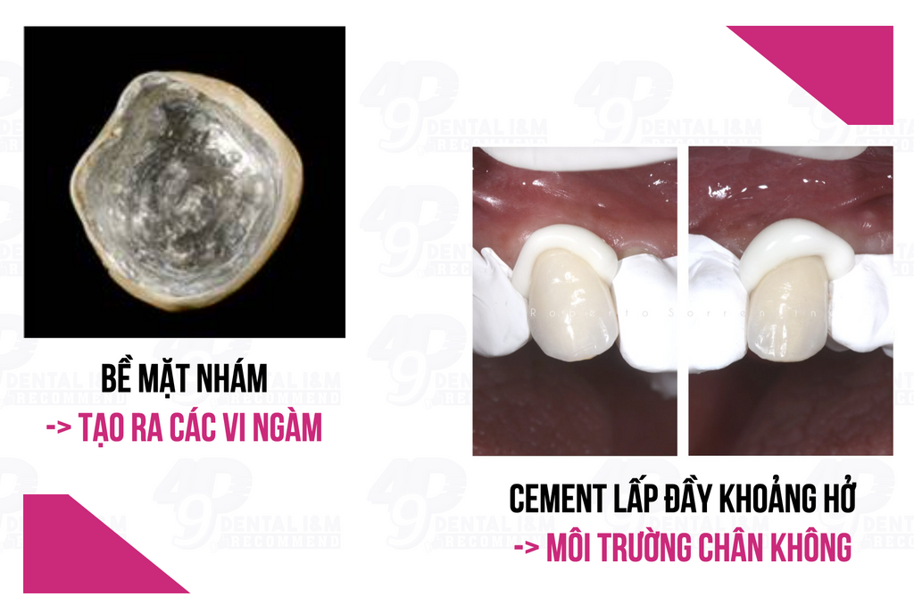 Cơ chế dán dính của cement RMGIs với bề mặt kim loại mão răng - 49P