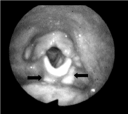 Normal swallow seen on FEES – one surface structure seen at a time