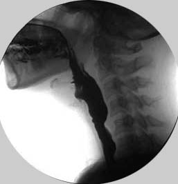 Normal swallow on MBSS - all structures seen at one time