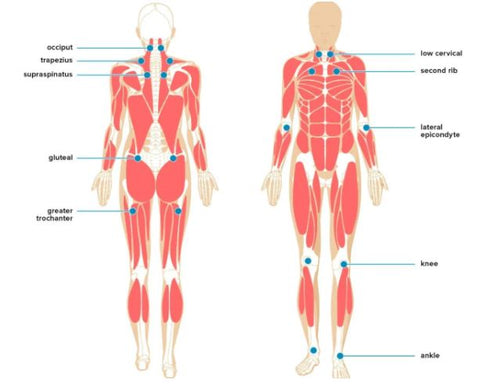 myofascial pain syndrome trigger points chart