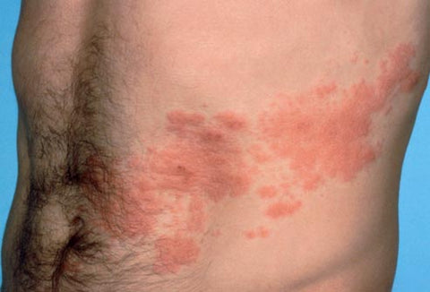 Shingles Rash Blister Zoster