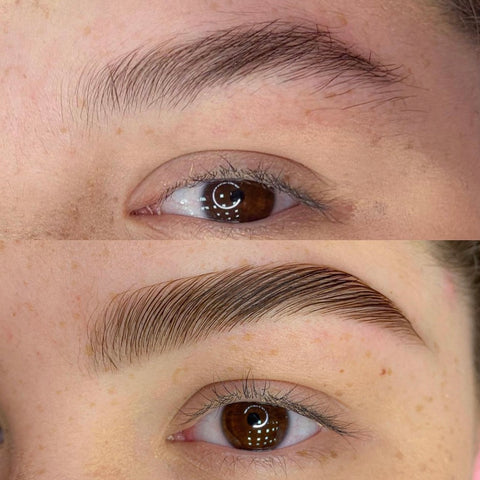 Brow lift before & after