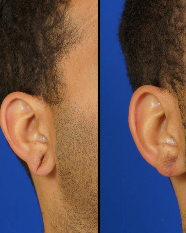 before and after photos of ear piercing related surgeries