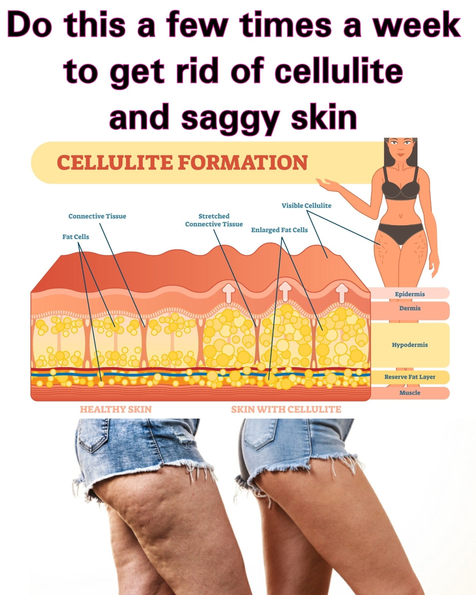 Little Known Facts About Cellulite: Treatment, Causes, Symptoms - Medcare.ae. thumbnail