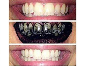 carbon-coco-charcoal-teeth-whitening-natural-crest-strips-colgate-skinnymint-drcharo-hottiedetox-best-before-after