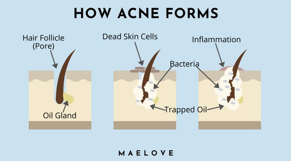 how acne forms