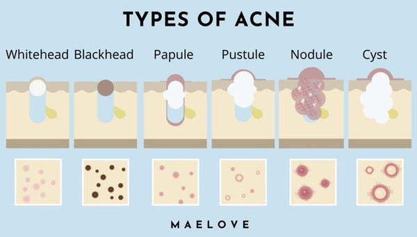 Different types of acne