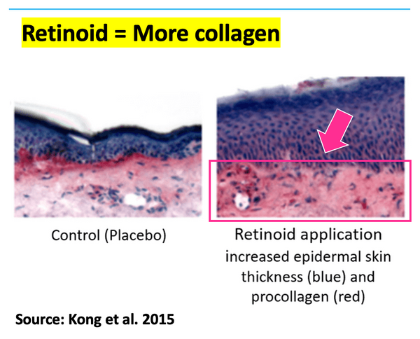 Retinoids lead to more collagen