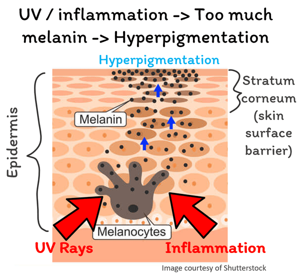 hyperpigmentation caused by UV