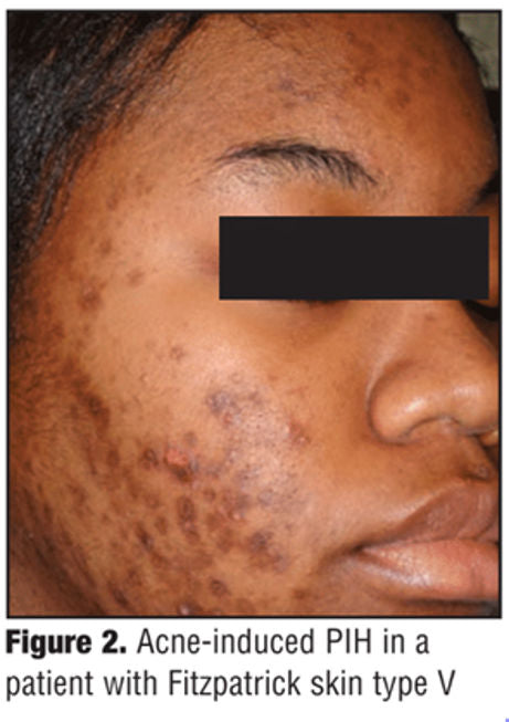 acne induced post inflammation hyperpigmentation (PIH)