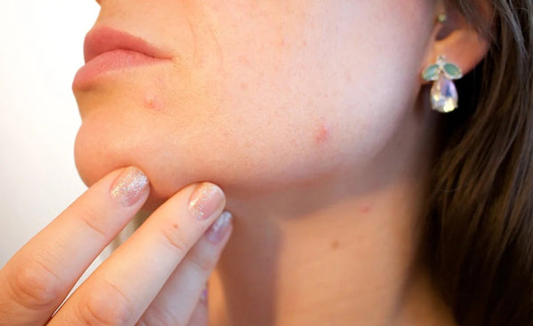 Woman With Damaged Skin And Pimples