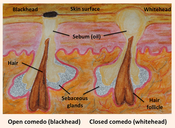 Illustration of sebum and how it causes acne