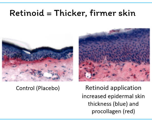 retinoids lead to firmer skin