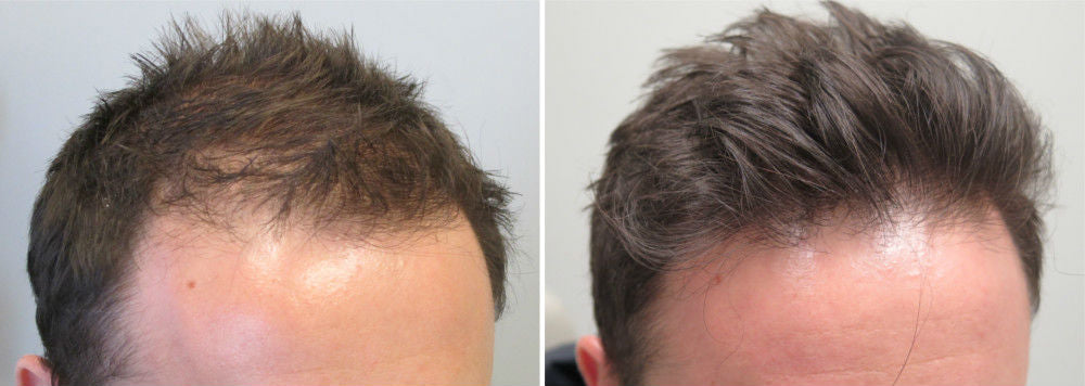 hairlust hair gummies før efter billede